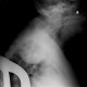Neurofibroma of the thorax: X-ray - Plain radiograph
